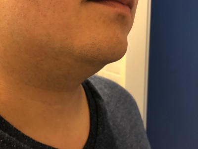 Porovnání oholení pomocí Philips OneBlade - PO
